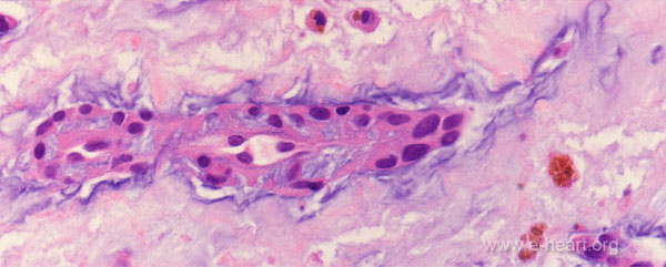 Myxoma Light microscopy 02